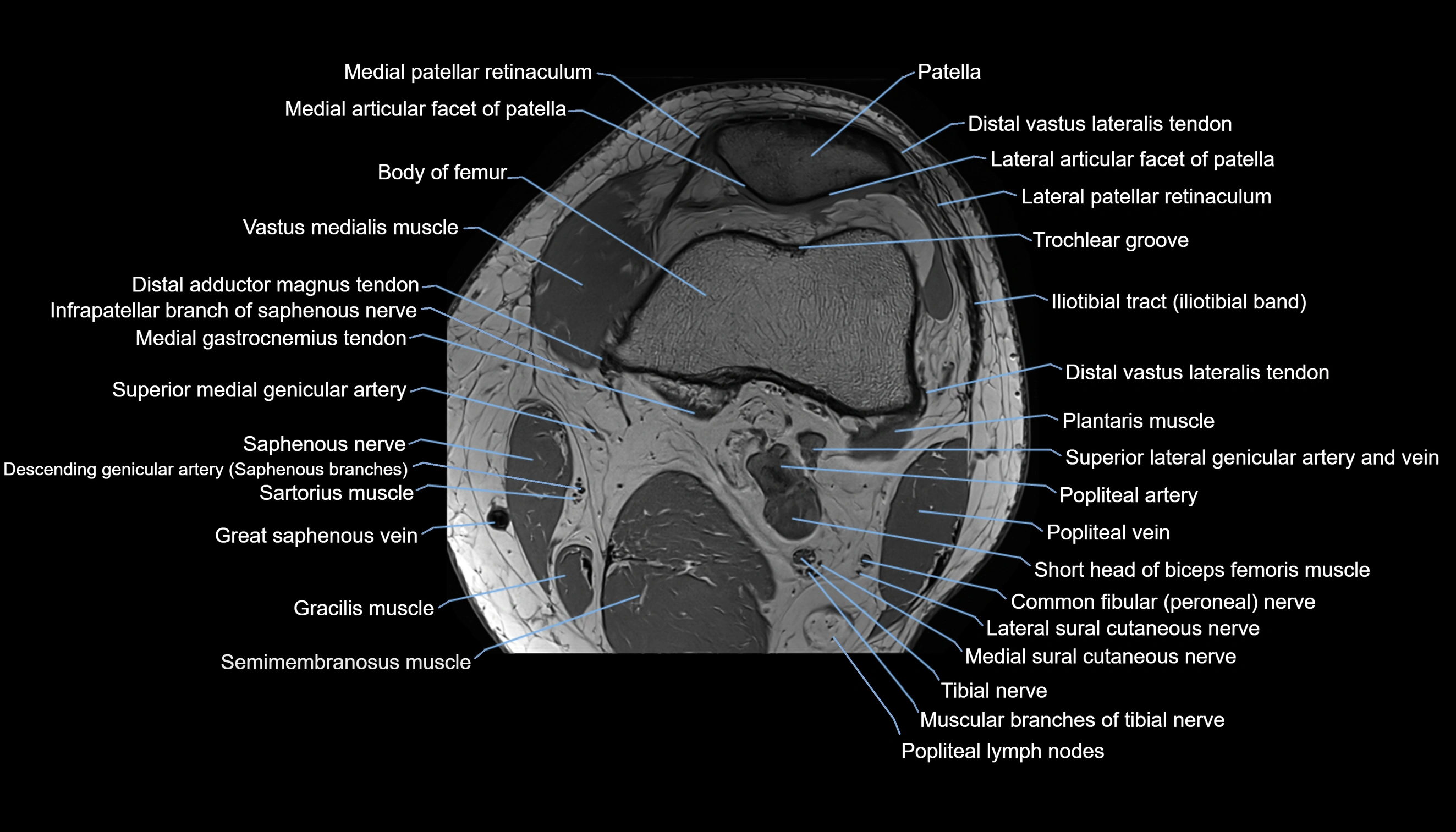 MRI knee  axial cross sectional anatomy 3T radiology  image-img-00001-00011.webp
